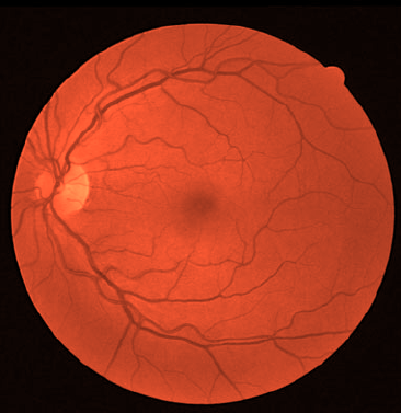 Fig-1-Green-channel-of-the-fundus-image_colored.png